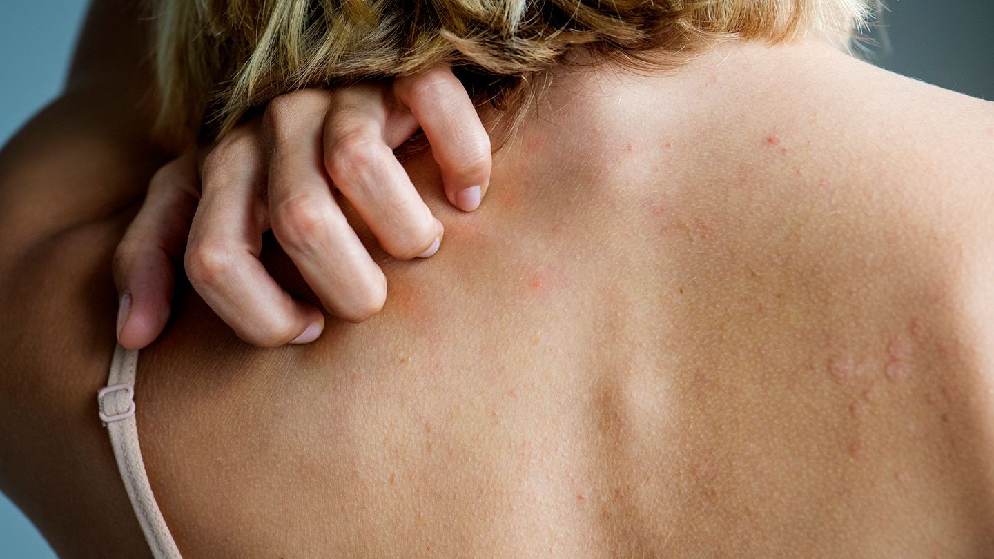 8 Common Types of Rashes and What They Look Like