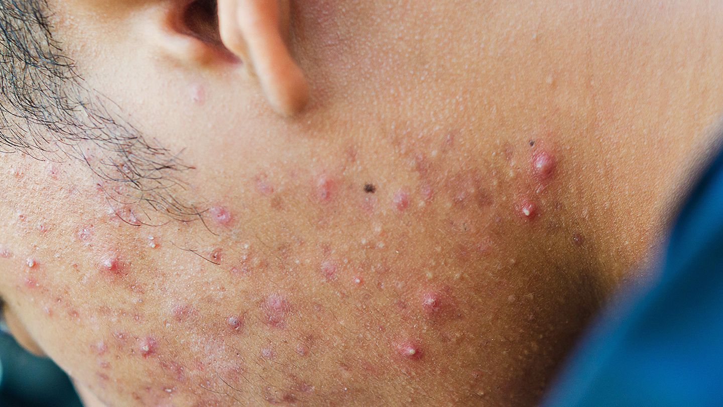 Better Acne Treatments May Be in Our Genes