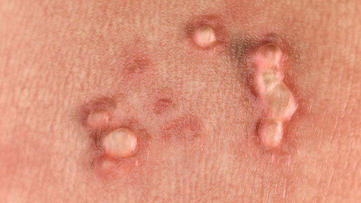 HPV Warts: The Misunderstood STD