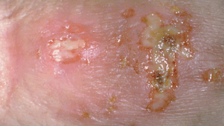 What Does Genital Herpes Look Like HSV-2 lesions