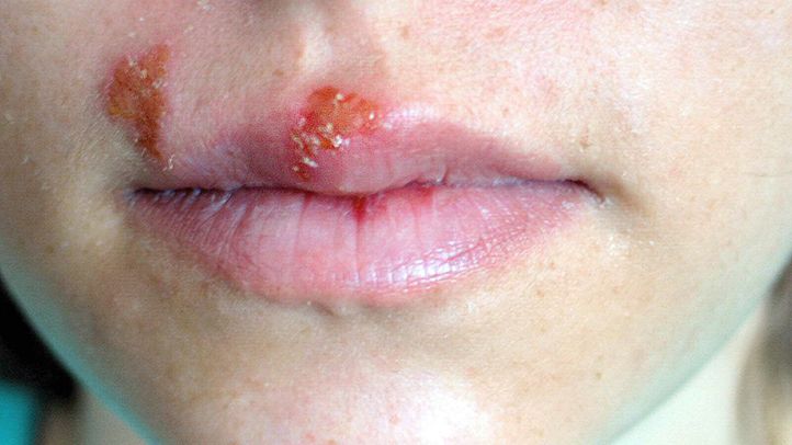 Oral Herpes Blisters Around the Mouth and Nose HSV-1 HSV-2