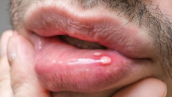 Are Canker Sores Caused by the Herpes Virus
