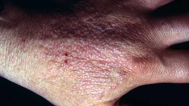 Contact Dermatitis Can Be Mistaken for Herpes