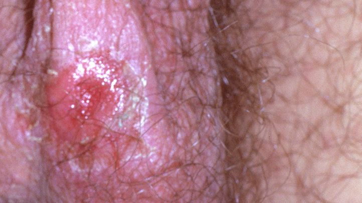 Syphilis STD sores genital area