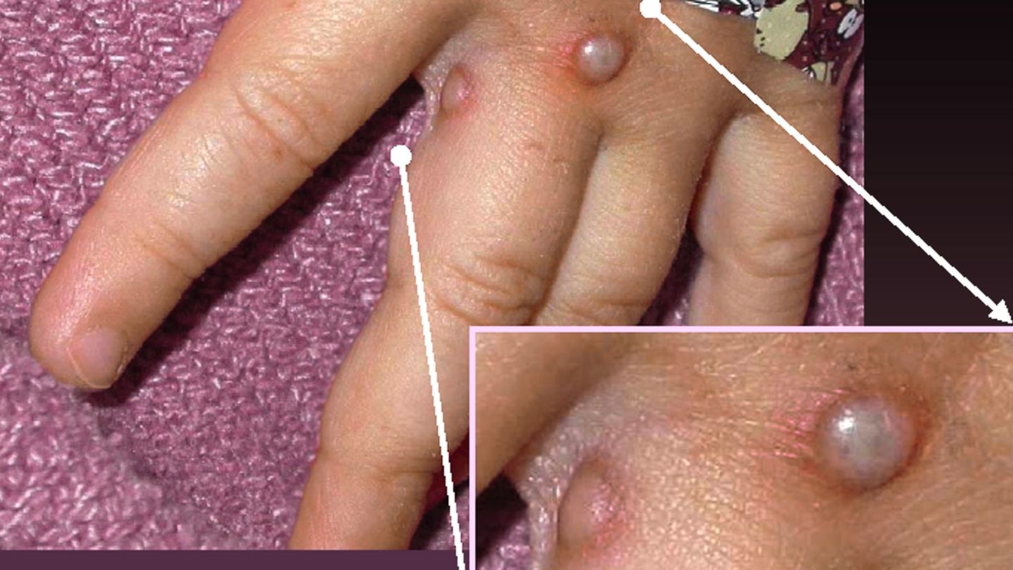 monkeypox virus on patient's hand