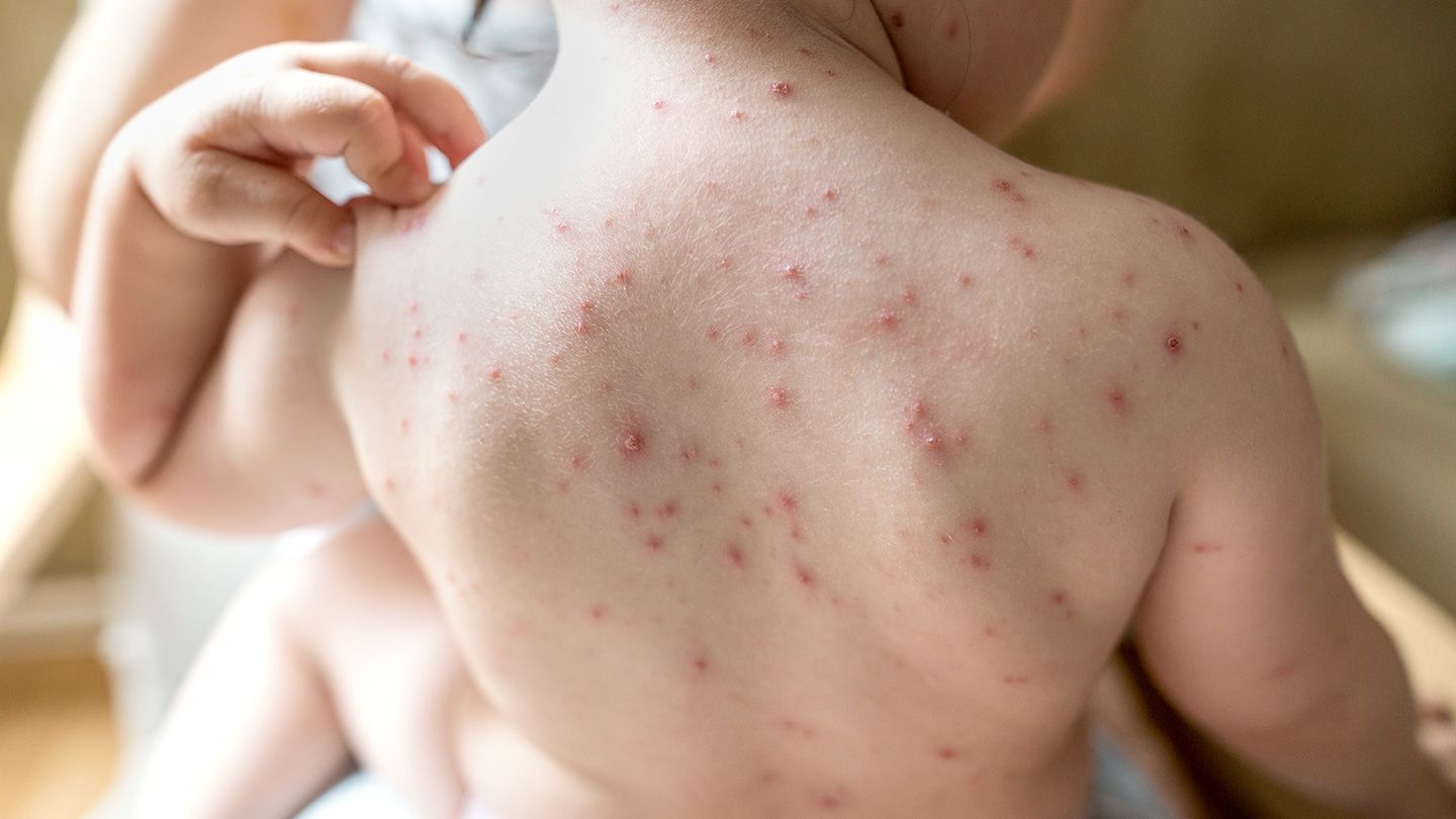 Is-It-Shingles-or-Something-Else-01-Chickenpox-1440x810