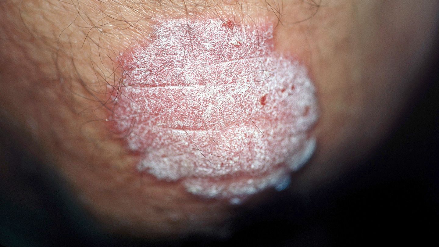 Is-It-Shingles-or-Something-Else-02-Psoriasis-1440x810