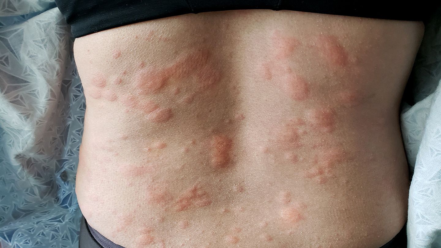 Is-It-Shingles-or-Something-Else-04-Hives-1440x810