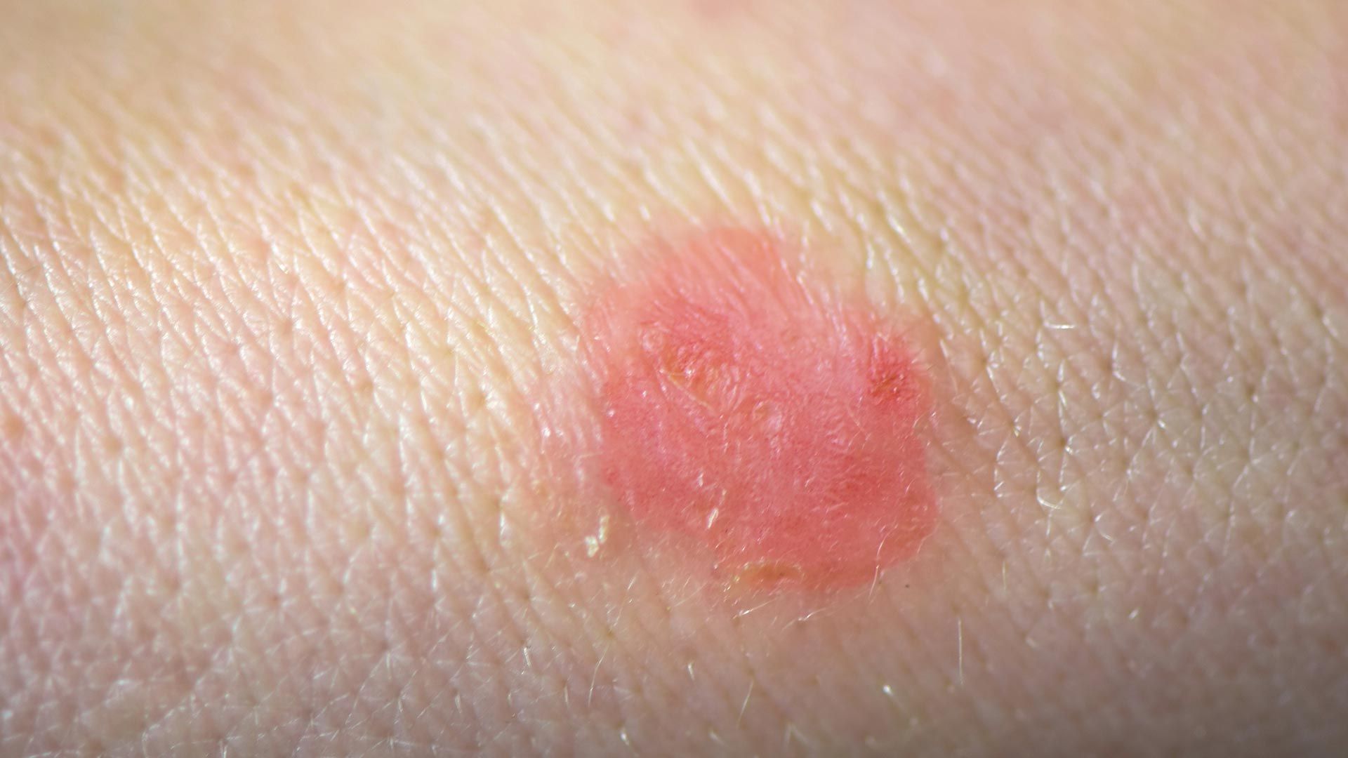 Skin-Conditions-You-Should-Know-About-01-Ringworm-1440x810