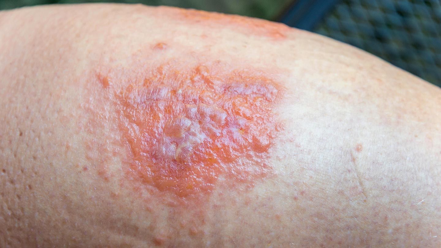 Skin-Conditions-You-Should-Know-About-04-Contact-Dermatitis-RM-1440x810
