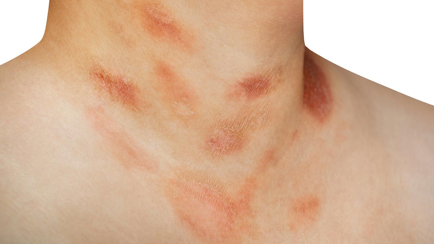 Skin-Conditions-You-Should-Know-About-07-Pityriasis-Rosea-1440x810