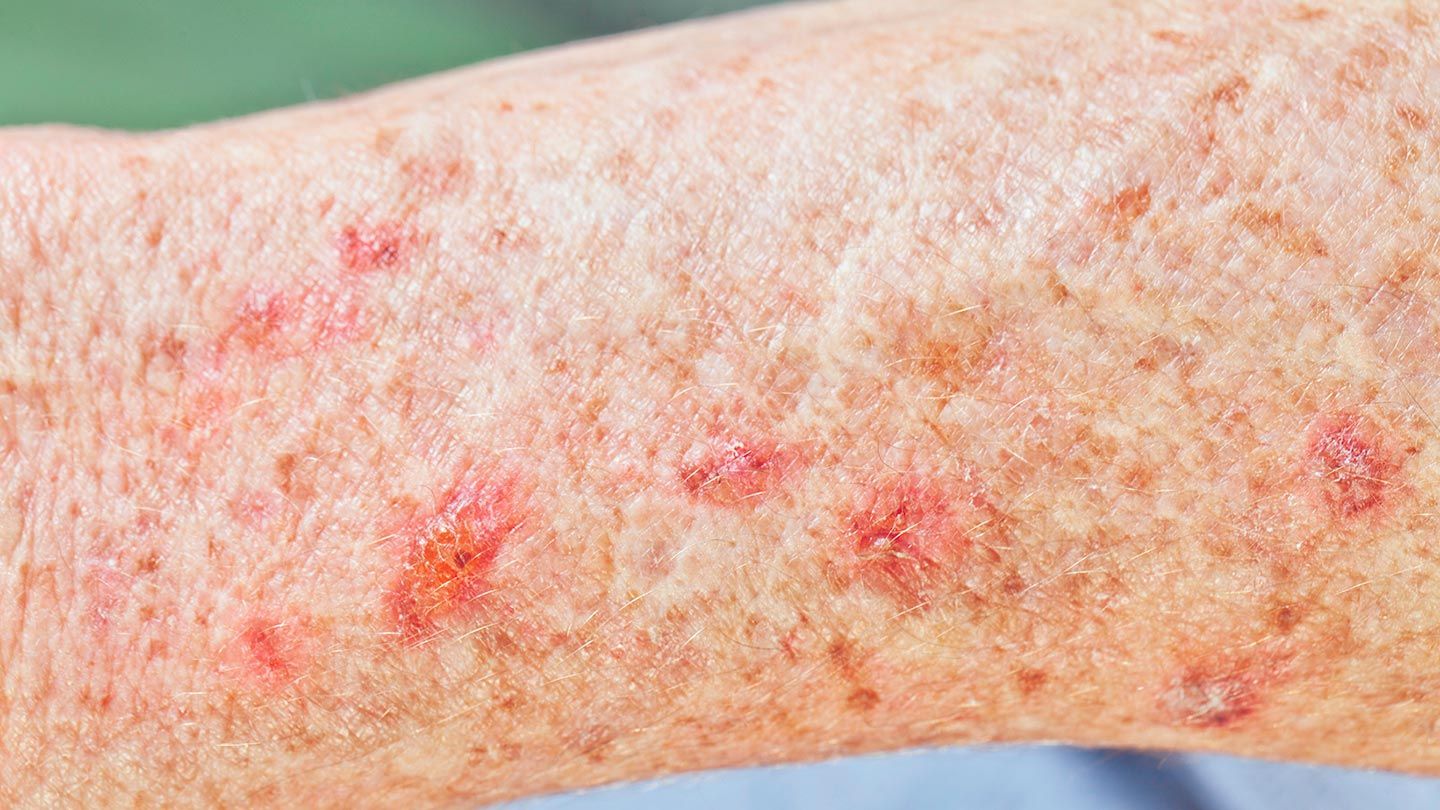 Skin-Conditions-You-Should-Know-About-08-Actinic-Keratosis-1440x810