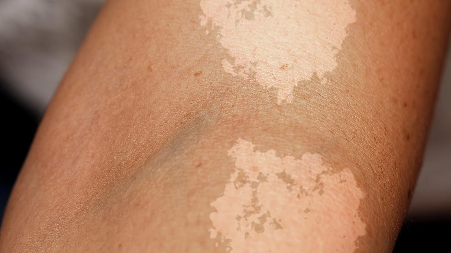Skin-Conditions-You-Should-Know-About-10-Tinea-Versicolor-1440x810