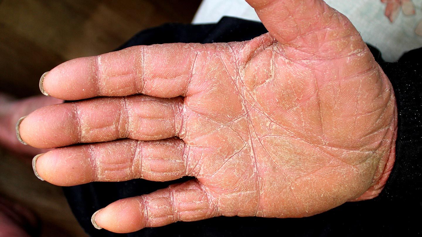 Skin-Conditions-You-Should-Know-About-11-Pityriasis-Rubra-Pilaris-1440x810