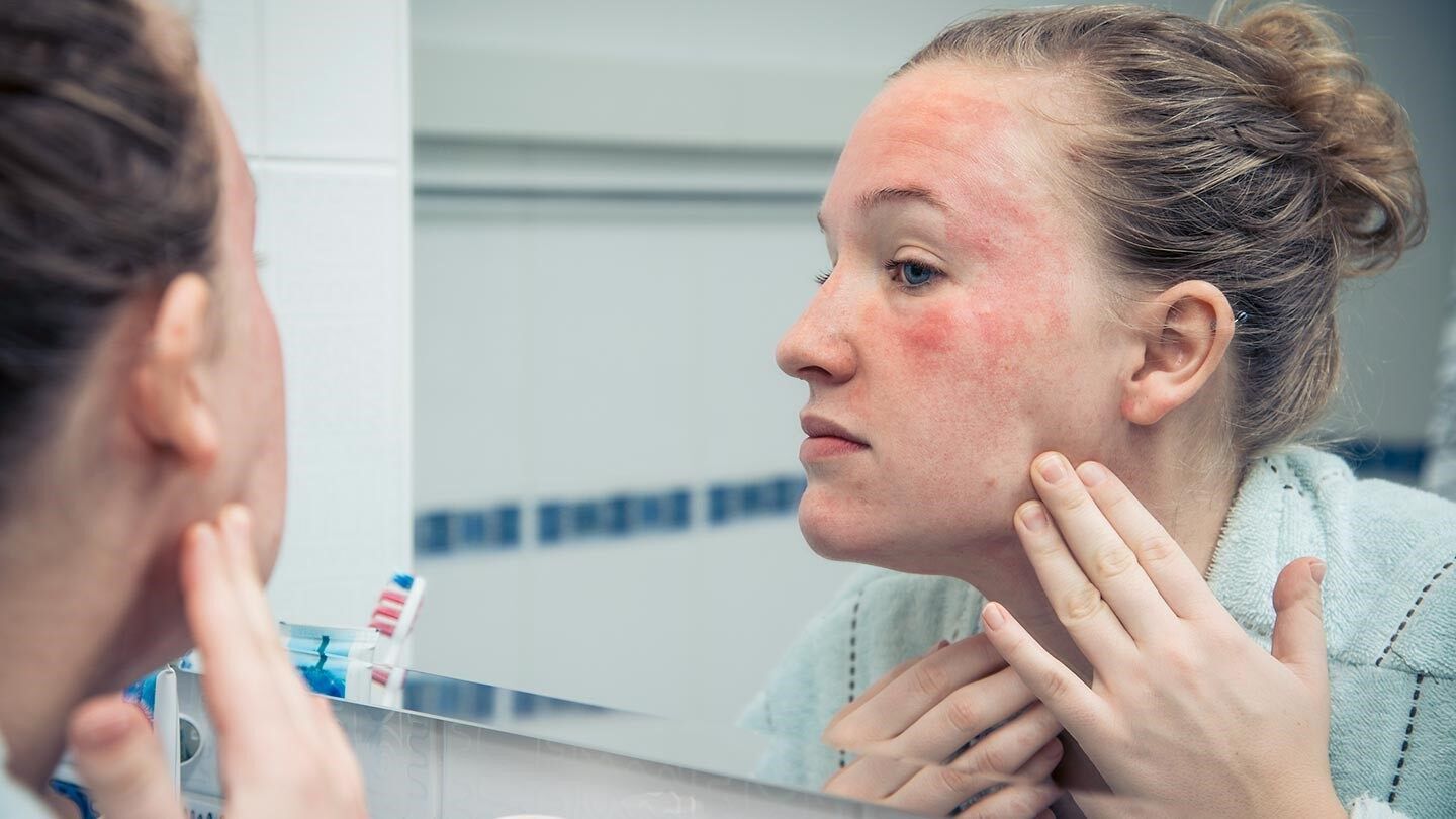a woman looking at her skin rash in the mirror