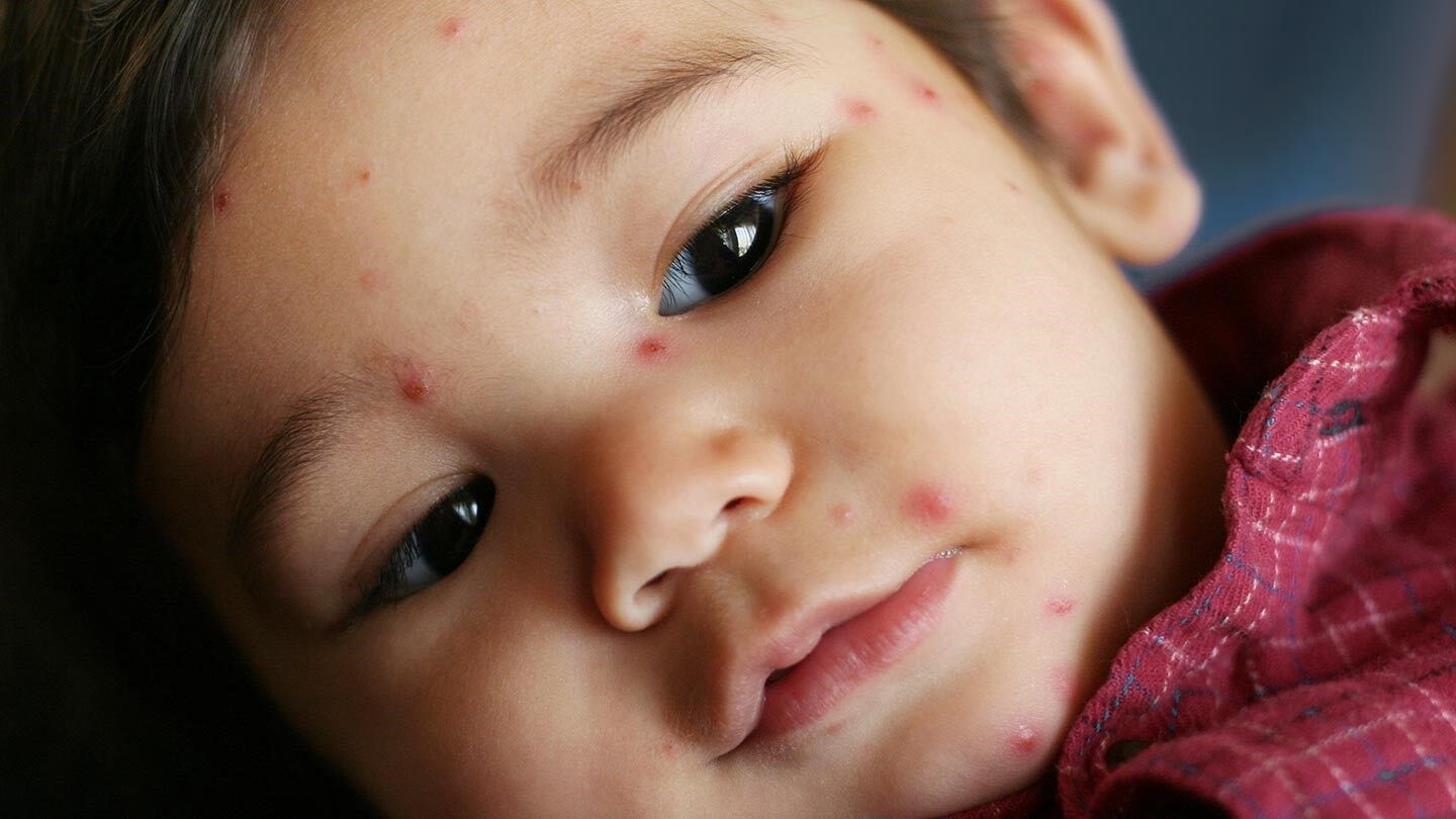 a child with the chickenpox