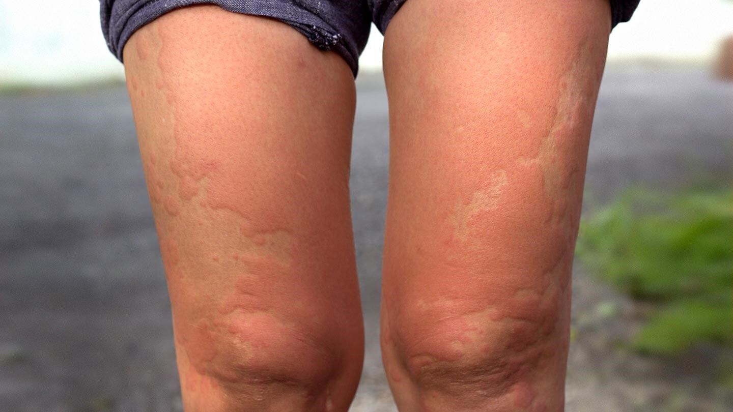 a person with hives on their legs