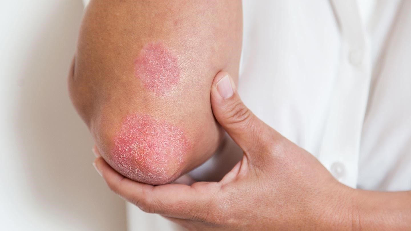 a person with psoriasis on their elbow