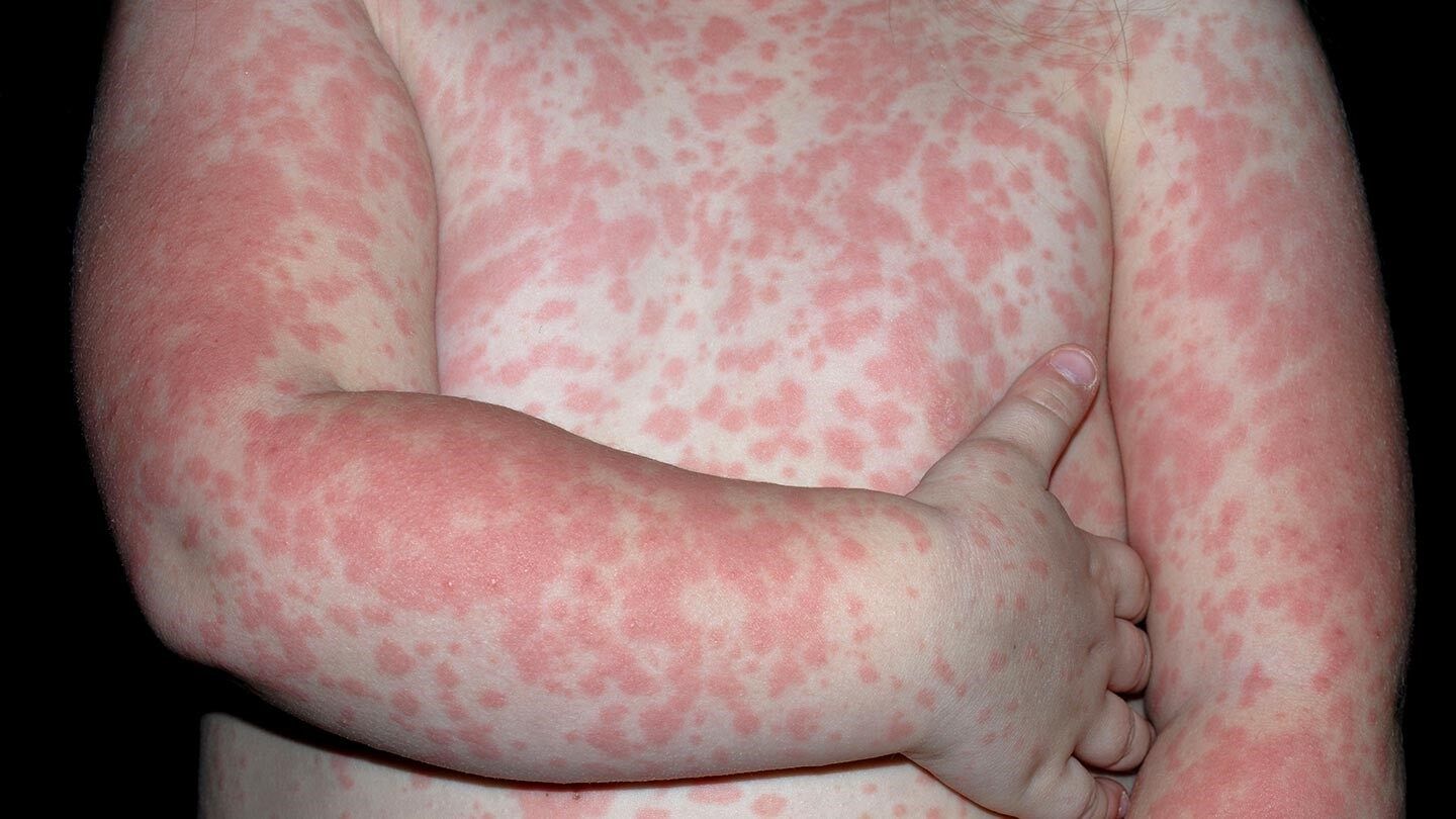a person with a skin rash caused by medication