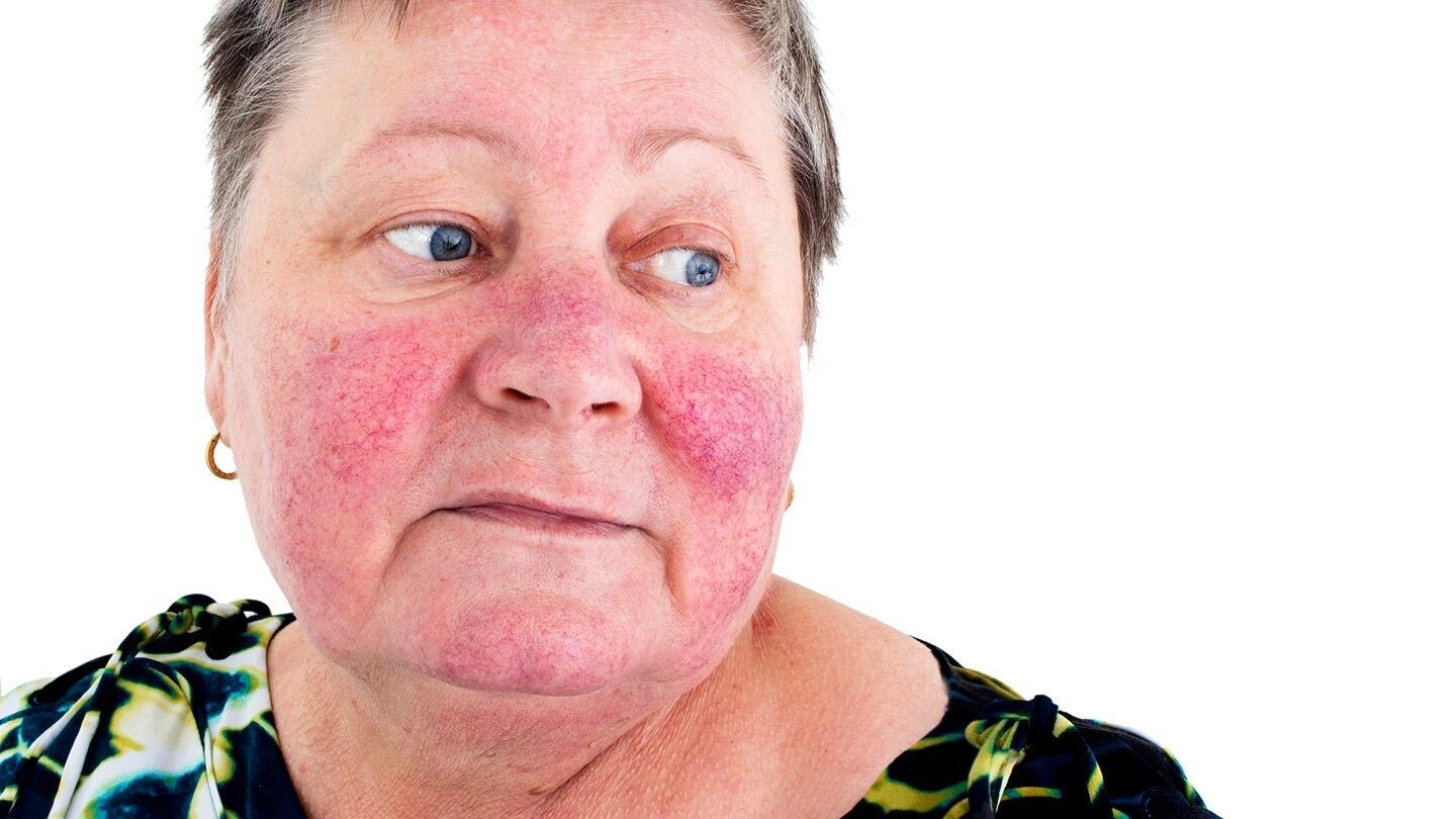 a woman with rosacea
