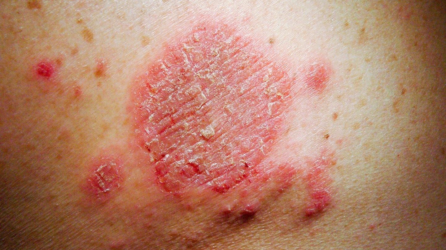 a patch of eczema