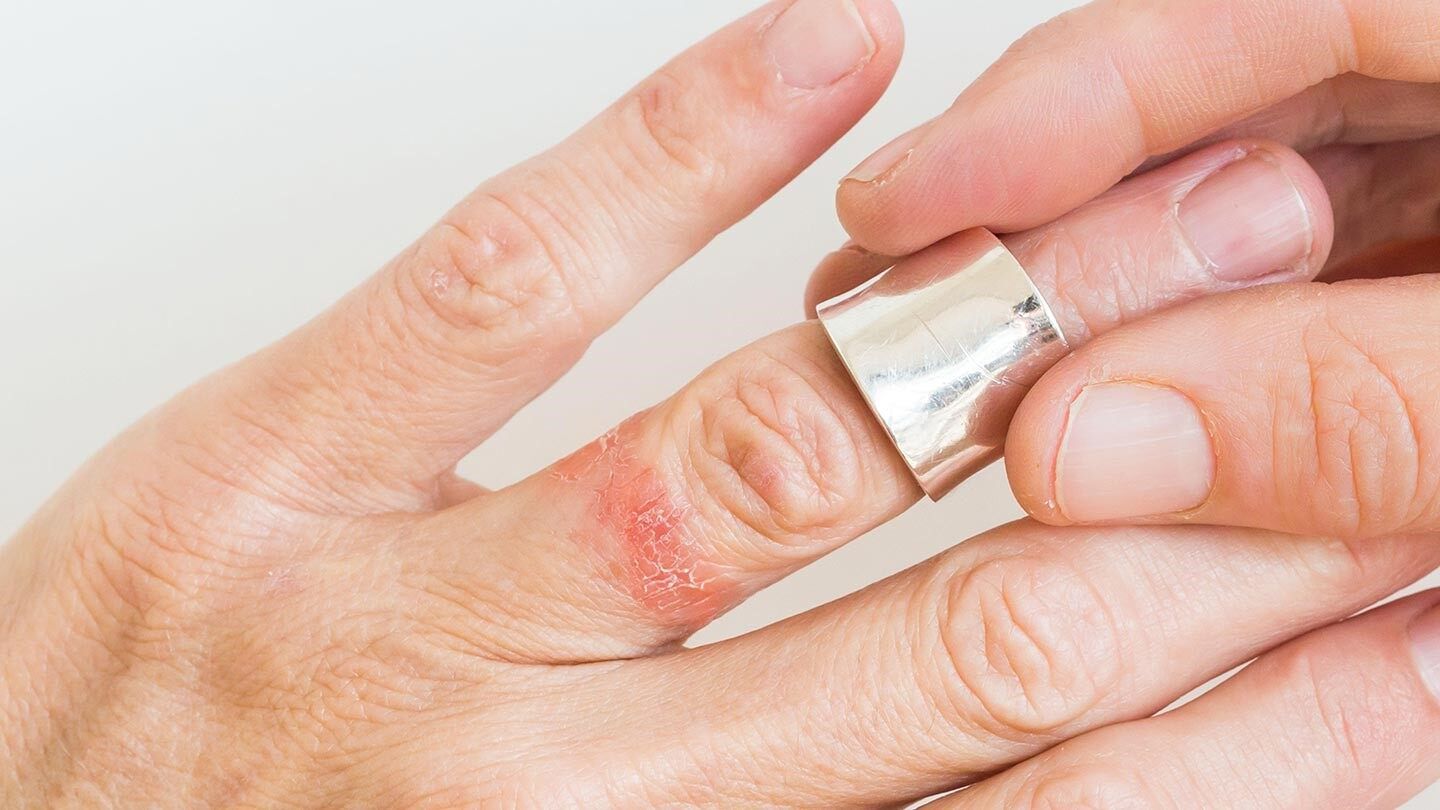 a person with contact dermatitis on their finger