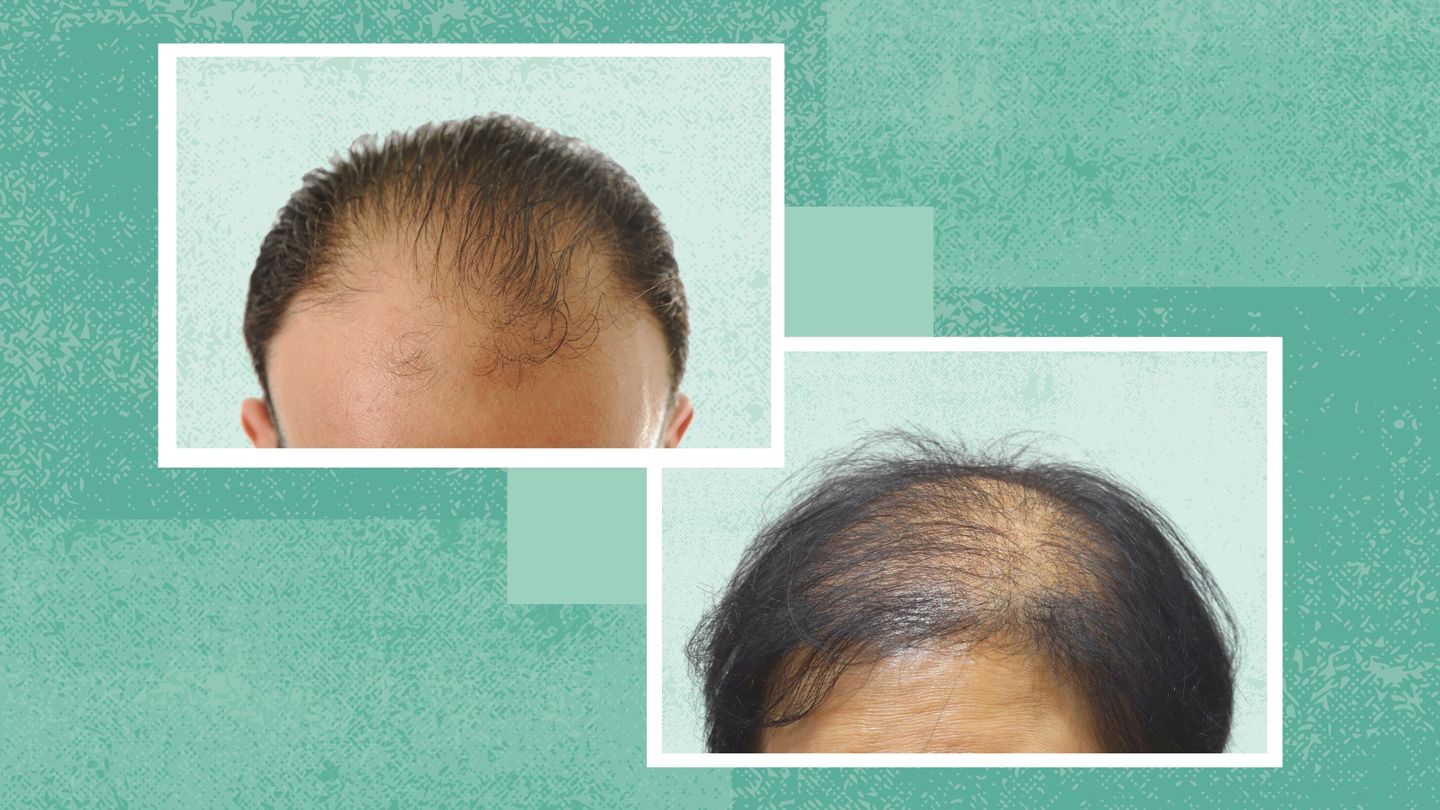 Male vs. Female Pattern Baldness (Androgenetic Alopecia): What’s the Difference?