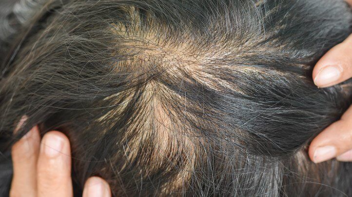 a person with thinning hair