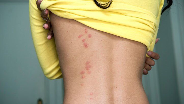 a person with bedbug bites on their back