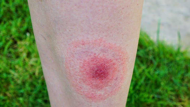 a tick bite that has turned into a bulls-eye which can signal lyme disease