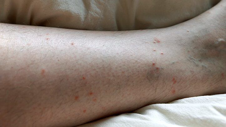 a person with flea bites on their legs