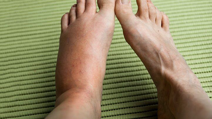 a person with a bee sting on their foot which has caused swelling