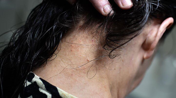 a woman with lice bites on the back of their neck