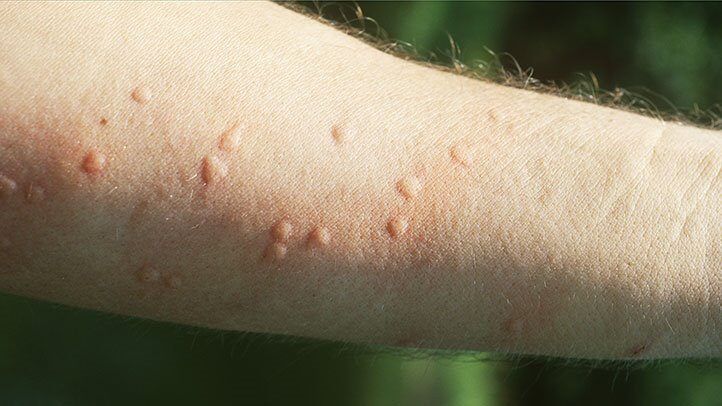 a person with ant bites on their arm