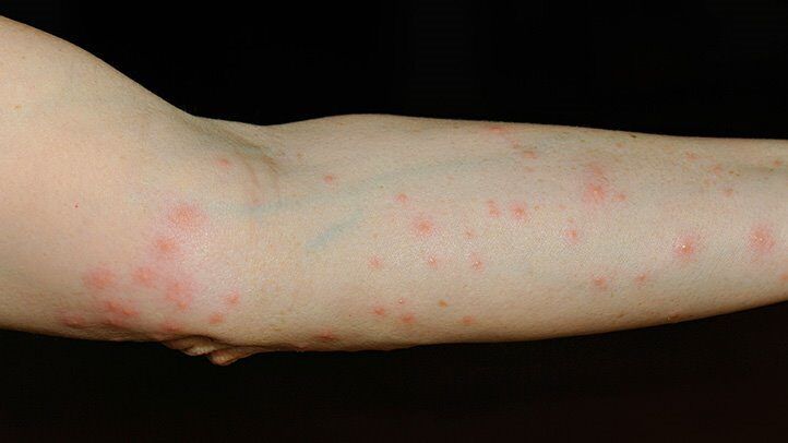 a person with mite and chigger bites on their arm