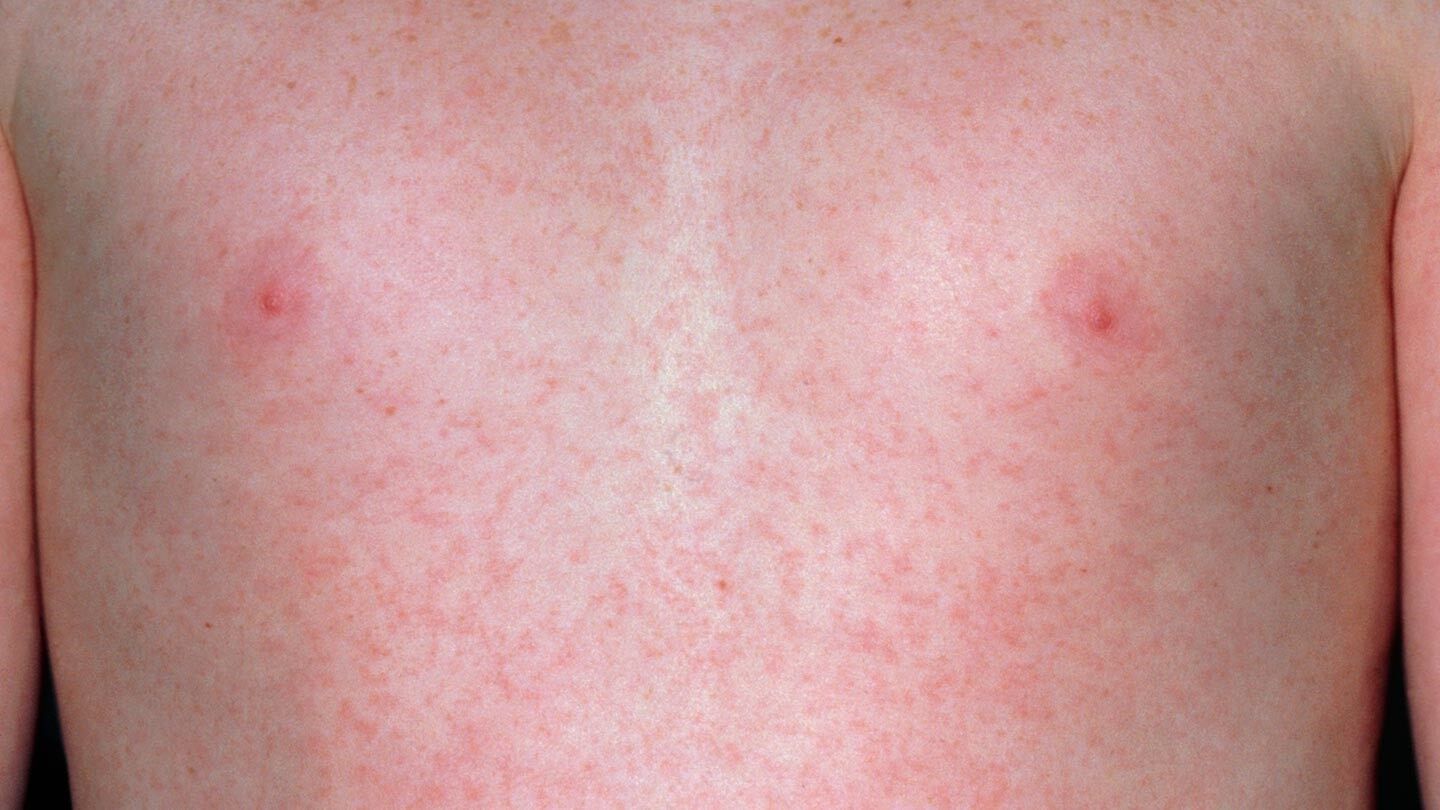 a person with rubella